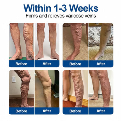 👨‍⚕️Hotplex®VeinFlow Microneedle Care Patch⚡Instant Relief, Long-Term Results