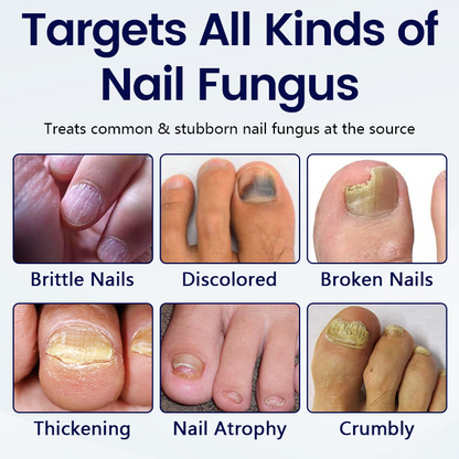 Acezozla® Anti-Fungal Nail Repair Patch